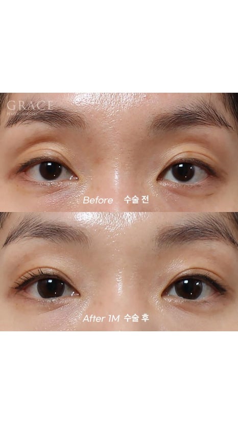 Eyebrow Hollow Fat Grafting Before and After Comparison – Gently Filling Sunken Eyes image 3