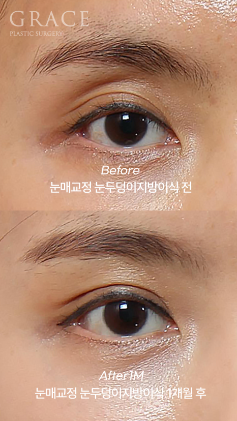 Side Effects of Eyelid Fat Grafting? One-Month Engraftment Period When Eyelid Correction Is Performed image 1