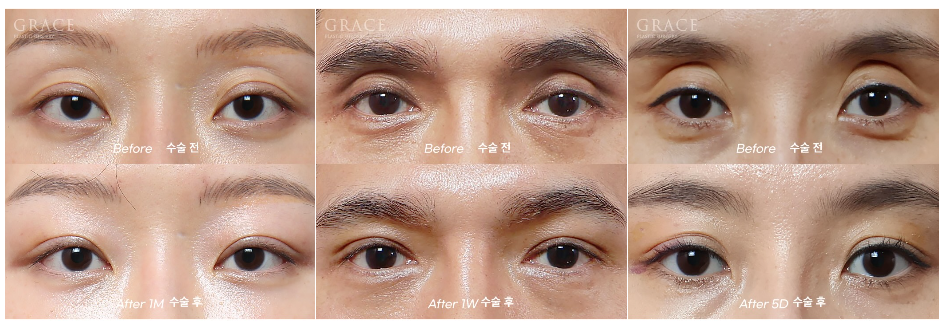 Why Eyelid Hollow Fat Grafting and Orbital Fat Injection Are Important: From Duration of Results to How to Prevent Bumpy Side Effects image 3