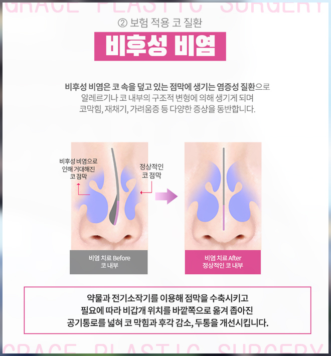 How Can You Reduce the Burden of Crooked Nose Surgery Costs? image 3
