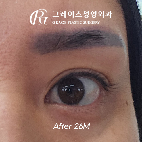 Before and After: Eyelid Fat Grafting Maintained for Over 2 Years in My Late 30s image 7