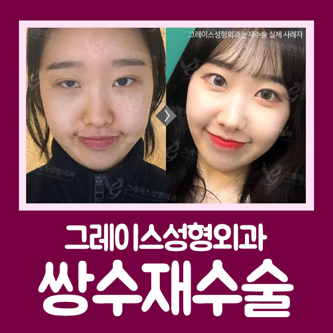 마지막 쌍수재수술 후기는 이곳에서 관련 이미지 3
