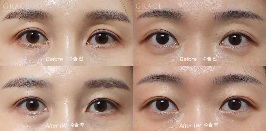 Grace Plastic Surgery’s Approach to Diagnosing Hollow Eye Socket Fat Grafting from the Structure image 4