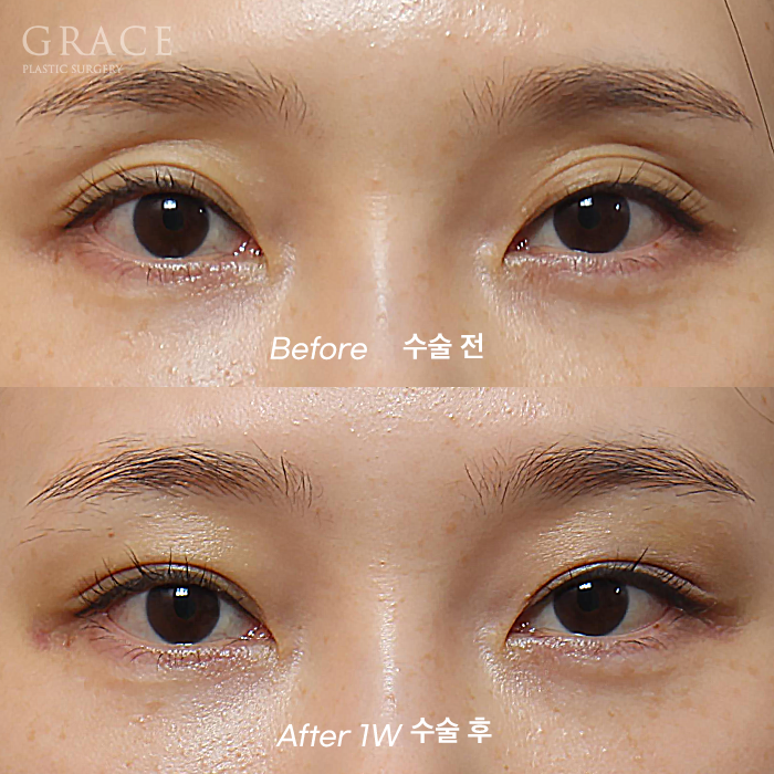 Will Eye Hollow Fat Grafting Really Deflate After 1 Month? 1-Week vs 2-Month Before-and-After Comparison image 1