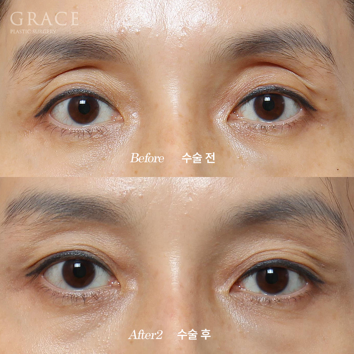 Why It’s Not Always Better Just Because Lower Eyelid Fat Grafting Is Cheap image 3
