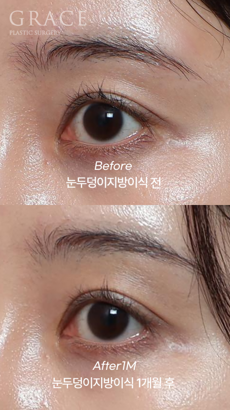For Those Saddened by Sunken Eyelids (Upper-Eyelid Fat Grafting) image 6