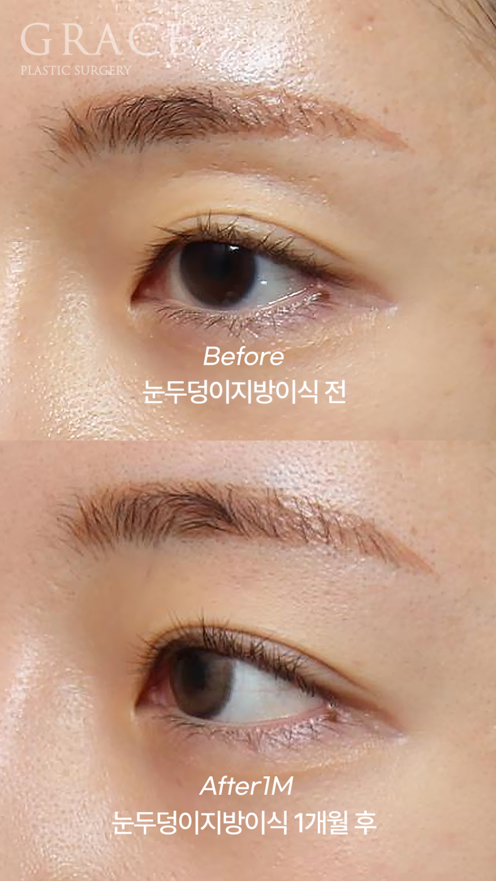 Why Eyelid Hollow Fat Grafting and Orbital Fat Injection Are Important: From Duration of Results to How to Prevent Bumpy Side Effects image 8