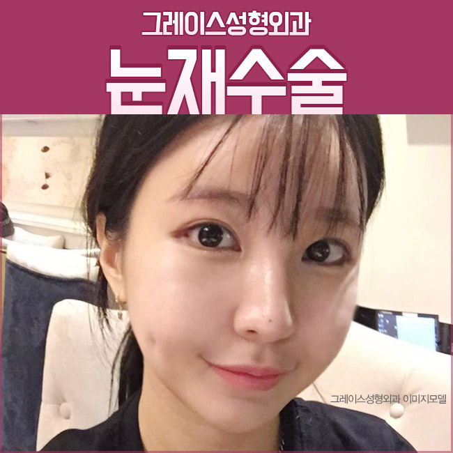 눈재수술성형외과는 그래! 그레이스성형외과 관련 이미지 2