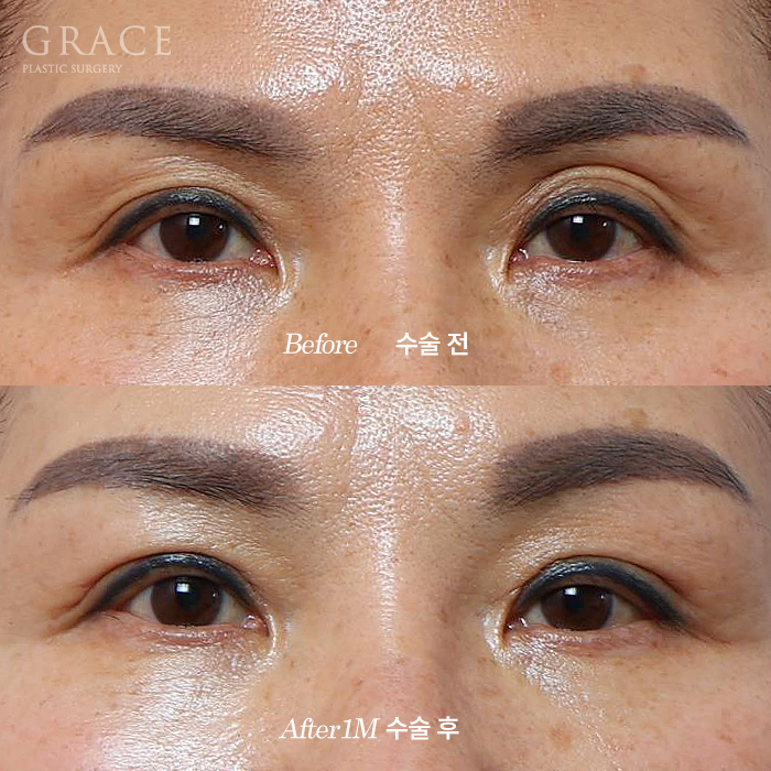Upper Eyelid Fat Grafting Side Effects? The Difference in Survival Rates Between Frozen Fat and Fresh Fat image 1