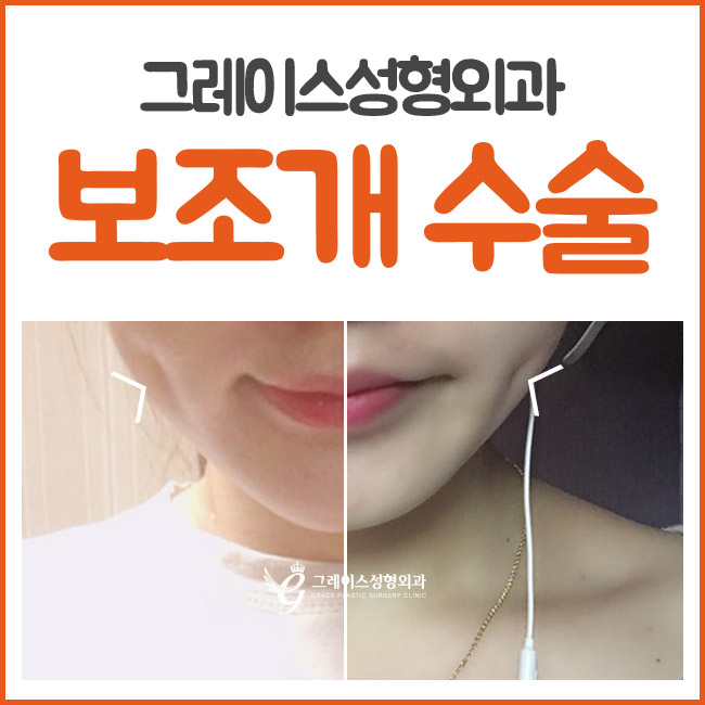 매력적인 이미지 변화는 보조개수술이 정답! 관련 이미지 4