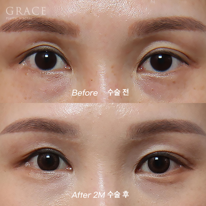 Upper Eyelid Fat Grafting Side Effects? The Difference in Survival Rates Between Frozen Fat and Fresh Fat image 5