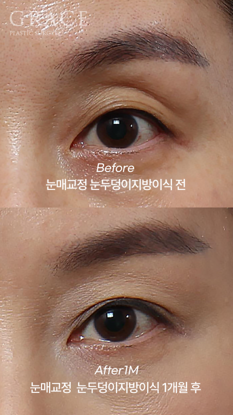 눈두덩이 지방이식 비절개 눈매교정 반드시 필요할까? (초이칼럼) 관련 이미지 1