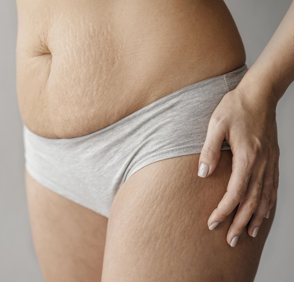 I Had Breast Augmentation for Sagging Breasts—Will It Cause Stretch Marks Too? image 1
