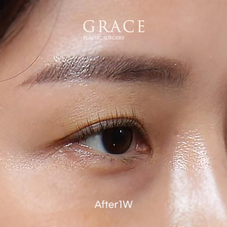 눈을 감았을 때 보이는 멍·흉터·울퉁불퉁함 걱정되나요? 눈두덩이 지방이식 관련 이미지 10