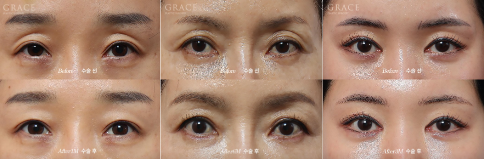 Why Eyelid Hollow Fat Grafting Fails If You Don’t Know This image 2