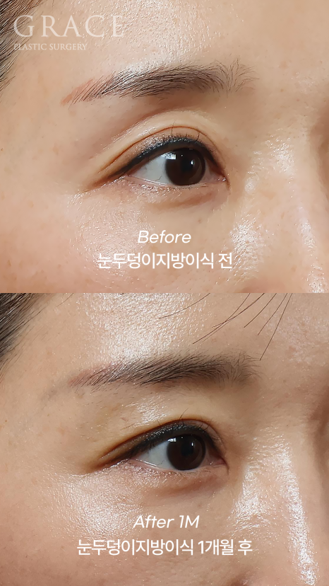Eyelid Fat Grafting Side Effects? How to Settle In Beautifully Without Lumps image 5