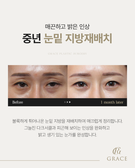 50대 절개눈매교정과 눈위지방이식 붓기는 얼마나 가나요? 관련 이미지 15