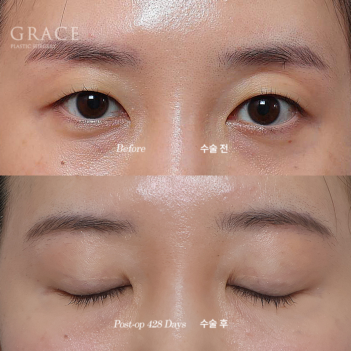 Will a Sunken Upper Eyelid Become Bumpy When You Close Your Eyes After Fat Grafting? image 11