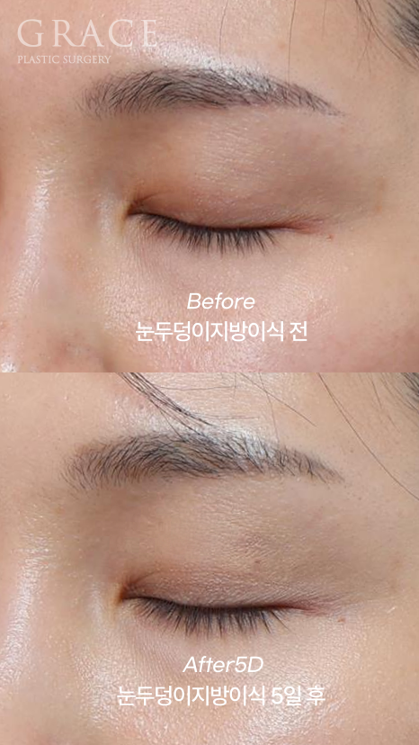 Eyelid Fat Grafting Bruising and Swelling Side Effects (Natural Eyelid Line After 5 Days) image 3