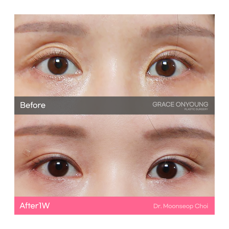Eyelid Fat Grafting (Sunken Eye Hollowing) image 3