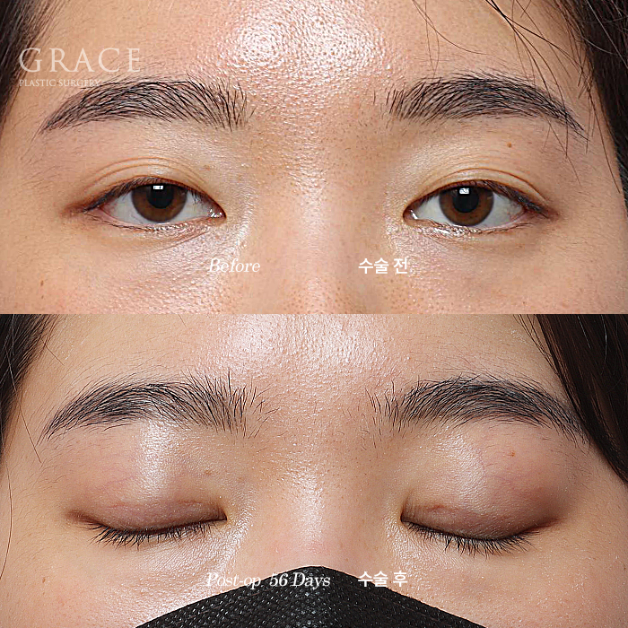 Will a Sunken Upper Eyelid Become Bumpy When You Close Your Eyes After Fat Grafting? image 9