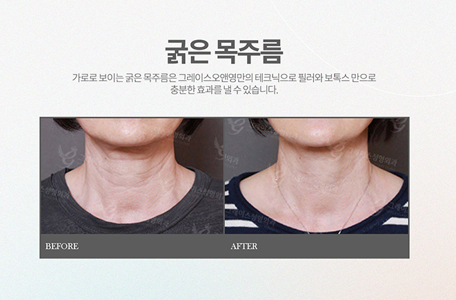그레이스오앤영 MACS_목리프팅 소개 관련 이미지 4