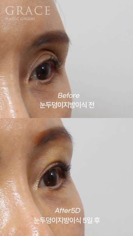 How Long Can Sunken Upper Eyelids Last Without Side Effects After Fat Grafting? image 6