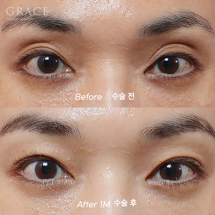 Understanding the Difference Between Forehead Fat Grafting (Eye Hollow Fat Grafting) and Fillers image 10