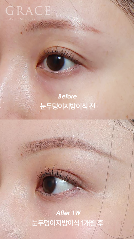 눈을 감았을 때 보이는 멍·흉터·울퉁불퉁함 걱정되나요? 눈두덩이 지방이식 관련 이미지 3