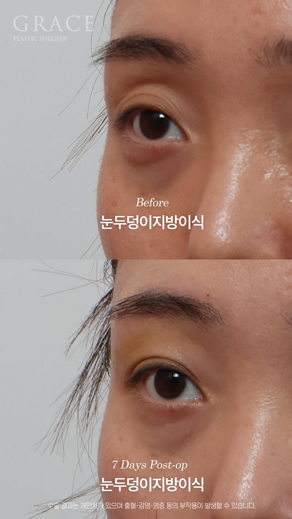 그레이스성형외과 눈두덩이 지방이식으로 채웠는데 눈이 더 잘 떠지는 이유 관련 이미지 6