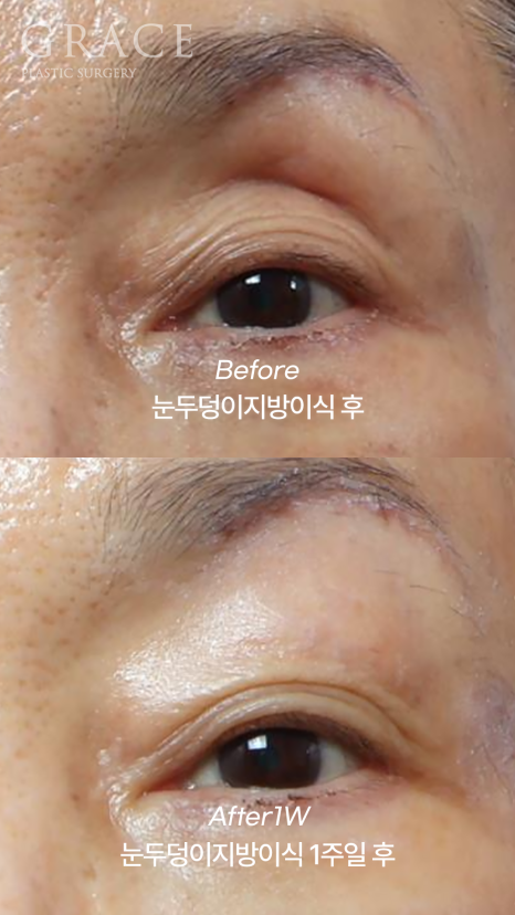 Upper Eye Hollowing and Sunken Brow Bone: Before and After 1 Week of Fat Grafting for a Patient in Her Mid-70s image 1