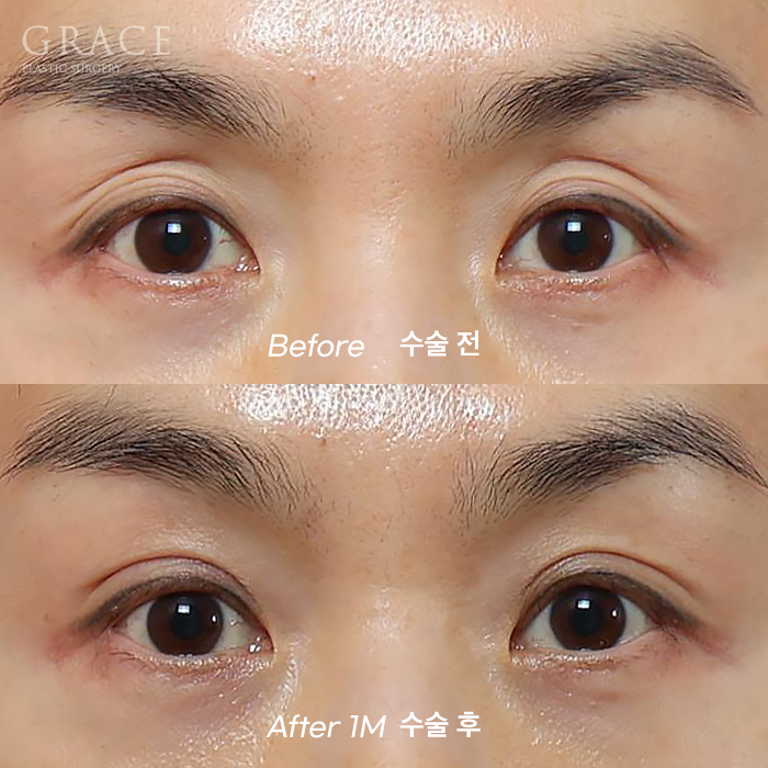 Upper Eyelid Fat Grafting Side Effects? The Difference in Survival Rates Between Frozen Fat and Fresh Fat image 3