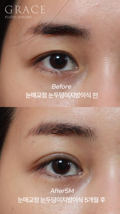 Introduction to a Case of Upper Eyelid Fat Grafting After Correction of Uneven Eyes image 3
