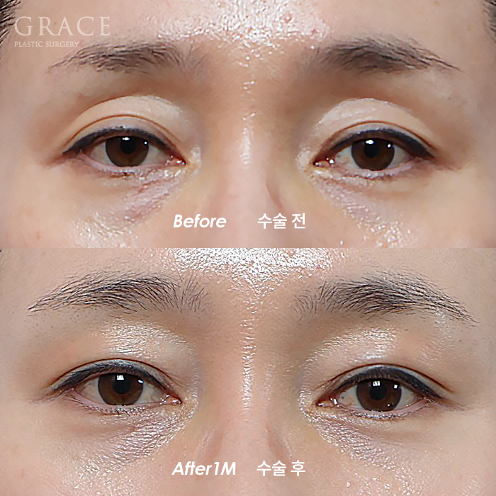 What Is the Problem with the Side Effects of a Lumpy Eyelid Fat Graft? image 1