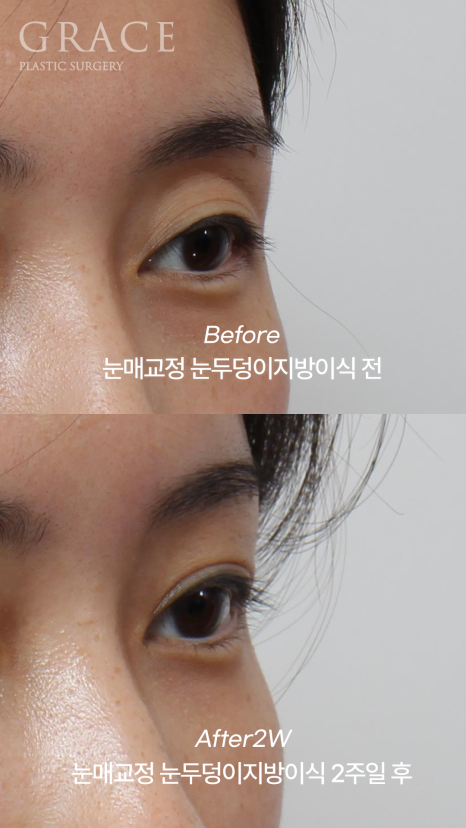 30대 눈두덩이 지방이식 + 눈매교정 + 눈밑지방재배치 BEFORE & AFTER 관련 이미지 5