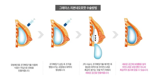 유방암 수술 후 유방재건수술은 그레이스성형외과 최문섭원장님에게 관련 이미지 3