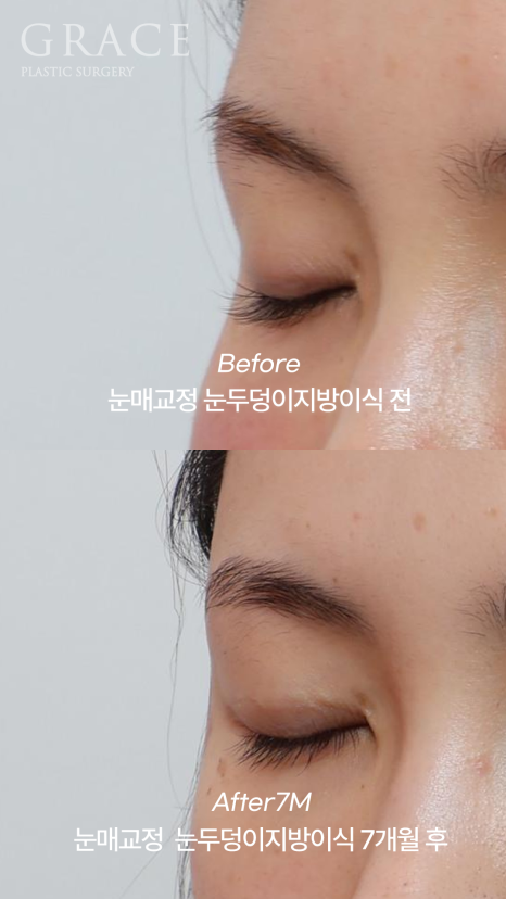 [20대 후반 눈꺼풀 지방이식+눈매교정]  7개월 후 유지력 이렇게 좋을 일? 관련 이미지 8