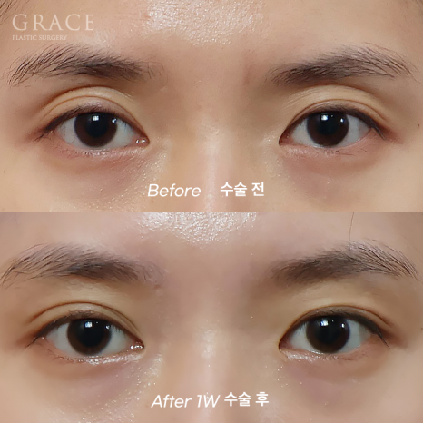 눈꺼풀지 방이식 심하게 꺼진 40대 눈 위 7일 만에 얼마나 달라졌을까? (그레이스성형외과 눈두덩이지방이식) 관련 이미지 7