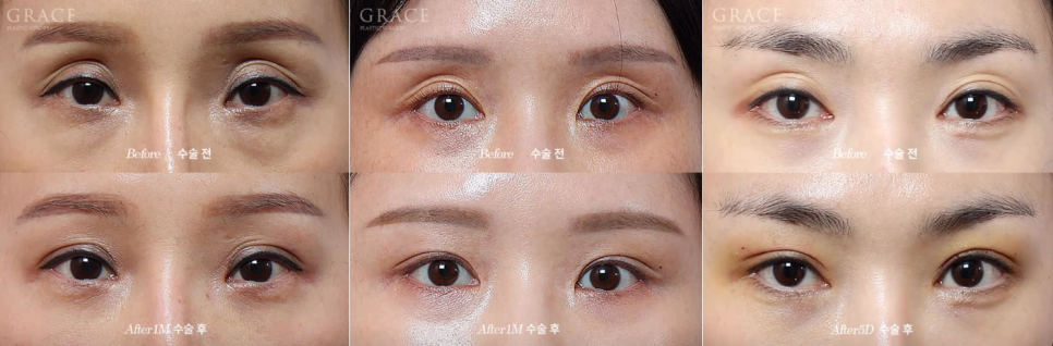 꺼진 아이홀 지방이식 유지기간과 부작용까지 알고 결정해야 하는 이유 관련 이미지 2