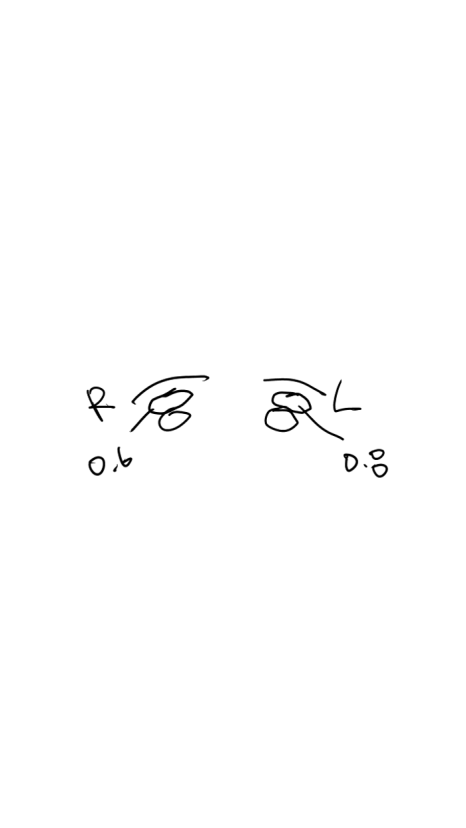 The Most Frequently Asked Symptom After Eyelid Fat Grafting: Yellow Bruising on the Eyelids image 2