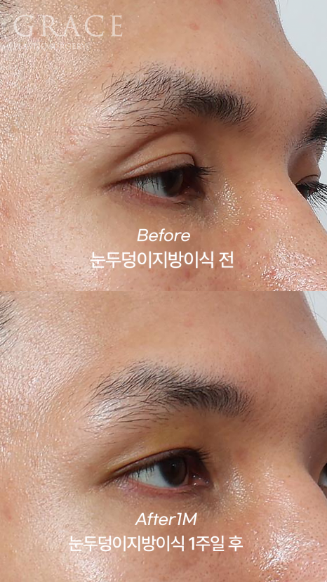 Why Injecting Fat Into the “Orbital Fat” Is Important in Sunken Eye Fat Grafting (dr.essay) image 6