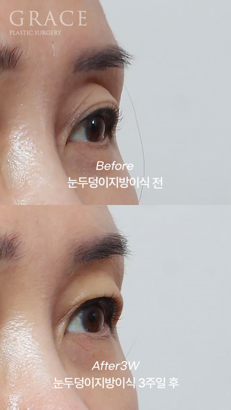 Celebrities with Sunken Eye Hollows, Filler Issue? Upper Eyelid Fat Grafting image 4