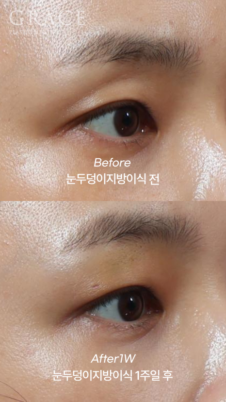 1 Week After Forehead Fat Grafting for Sunken Eyes: Honest Swelling Update image 5
