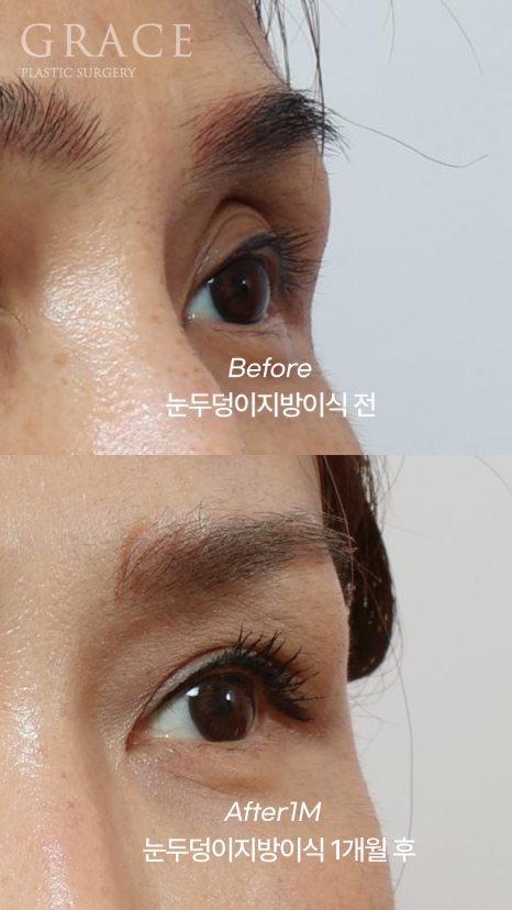 Uneven When You Close Your Eyes? Before-and-After of Eyelid Fat Grafting That Took Well Without Swelling (Compared with Filler) image 4