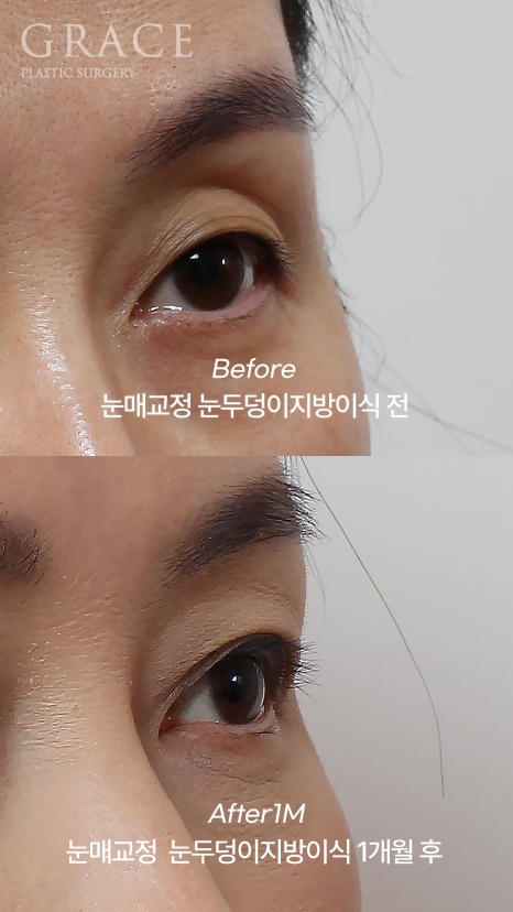 눈두덩이 지방이식 비절개 눈매교정 반드시 필요할까? (초이칼럼) 관련 이미지 4