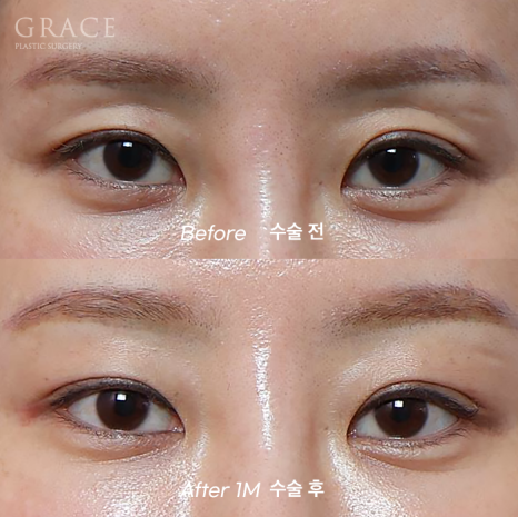 Eye Fat Grafting Instead of Eyelid Filler: Eye Shape Correction (1-Week Swelling Level) image 7