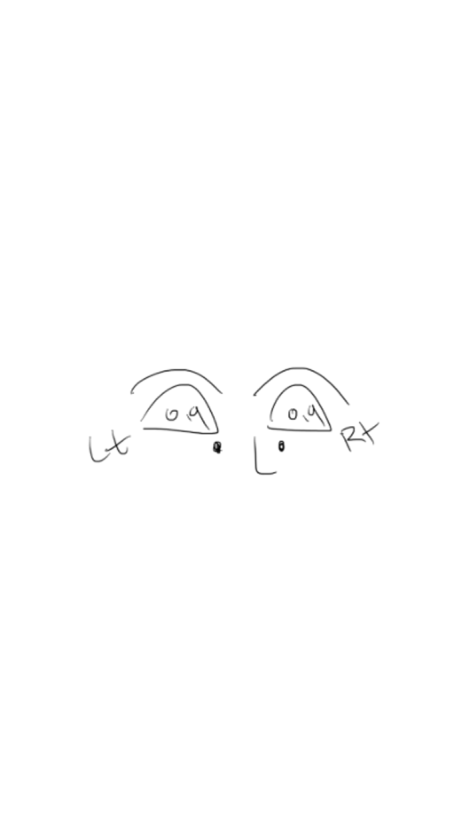 눈꺼풀 지방이식 수술 After l 30대 후반 10일 차 붓기와 생착률 관련 이미지 2