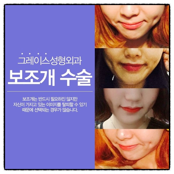 밋밋한 얼굴에 뽀~인트! 그레이스성형외과 보조개 수술 관련 이미지 1