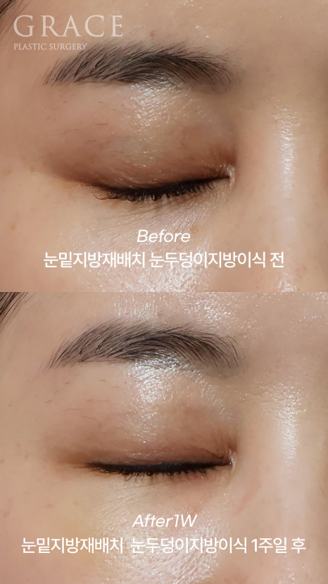 Under-Eye Fat Repositioning & Eyelid Fat Grafting: Double the Swelling? Before and After 1 Week image 4