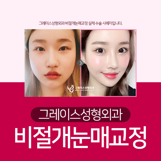 비절개눈매교정 안검하수를 교정해 또렷한 눈매를! 관련 이미지 2